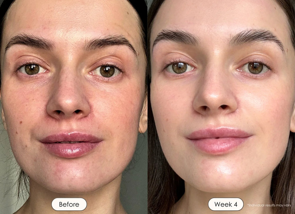 Redness, Hyperpigmentation