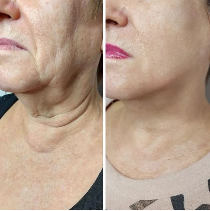Fine Lines, Skin Dullness