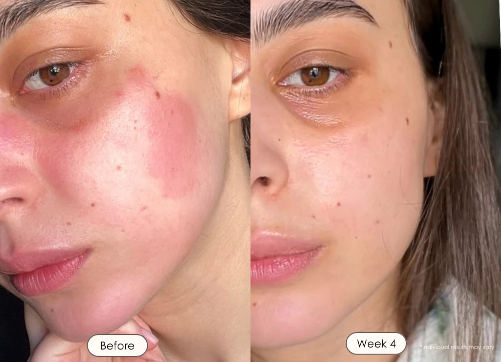 Inflammation, Uneven Skin Tone