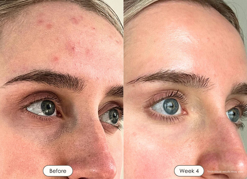 Uneven Skin Tone & Hyperpigmentation