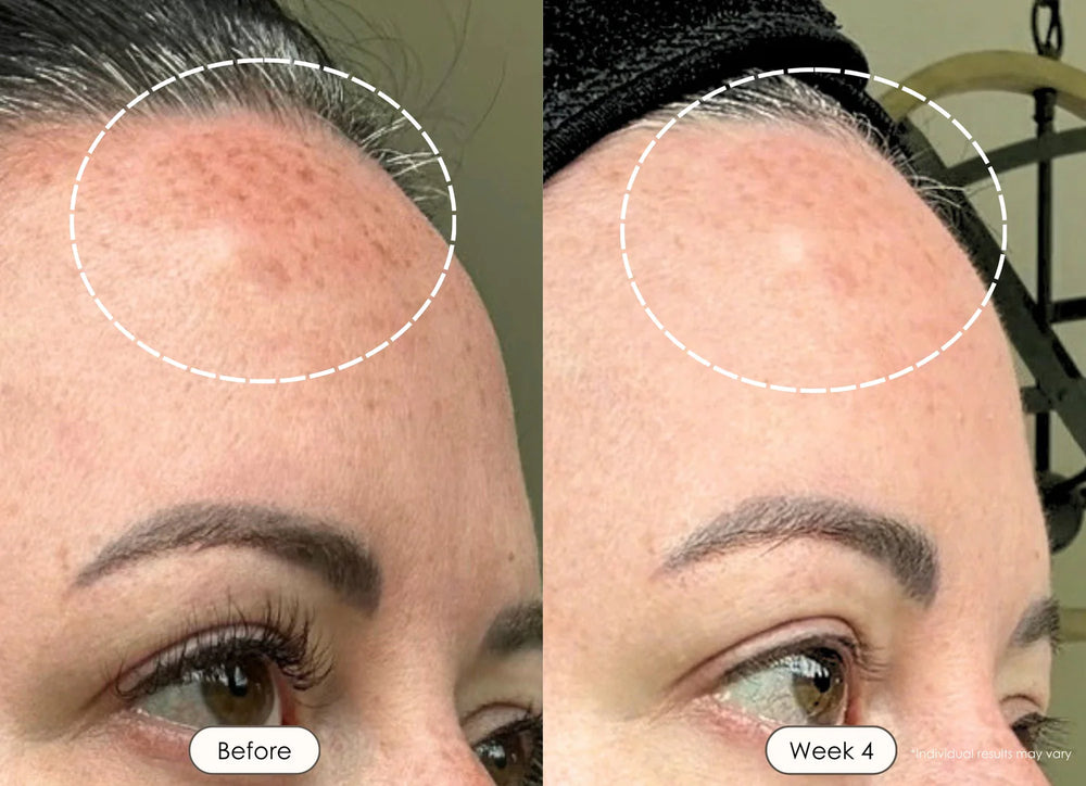 Acne & Scars