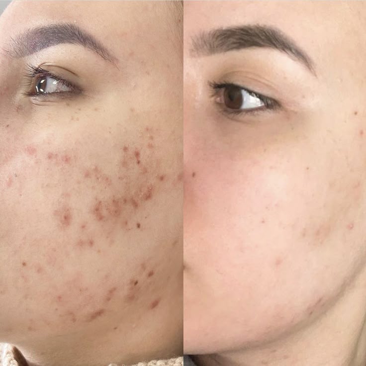 Uneven Skin Tone & Hyperpigmentation